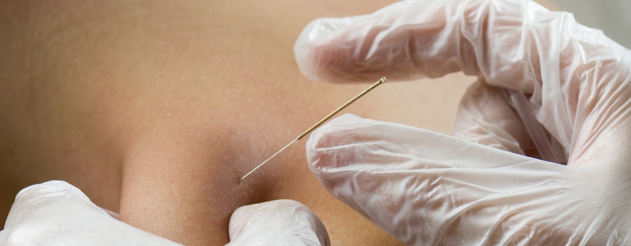 physical-therapy-clinic-dry needling-hope-physical-therapy-myrtle-beach-sc