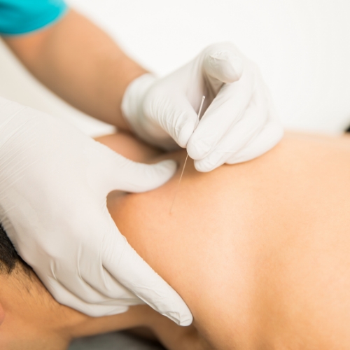 physical-therapy-clinic-dry-needling-hope-physical-therapy-myrtle-beach-sc